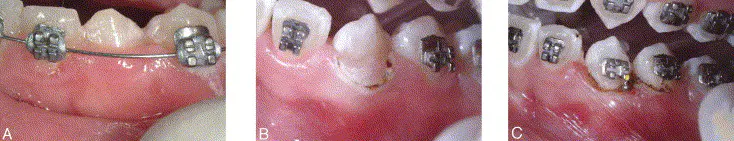 Different examples of bracket placement