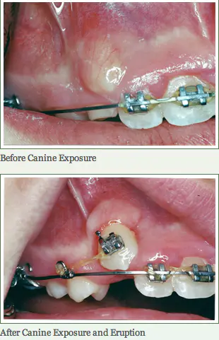 Before and after of canine impaction treatment