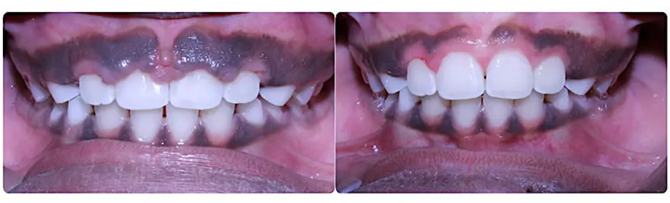 Before and after of a gingivectomy, or gum recontouring