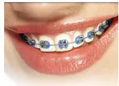 Metal Braces