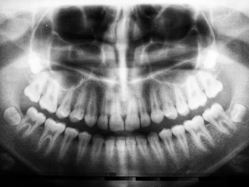 X-Ray of mouth including teeth and jawbones